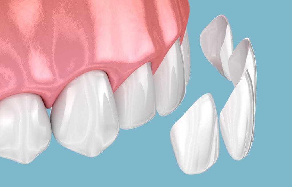 3d design of dental veneers